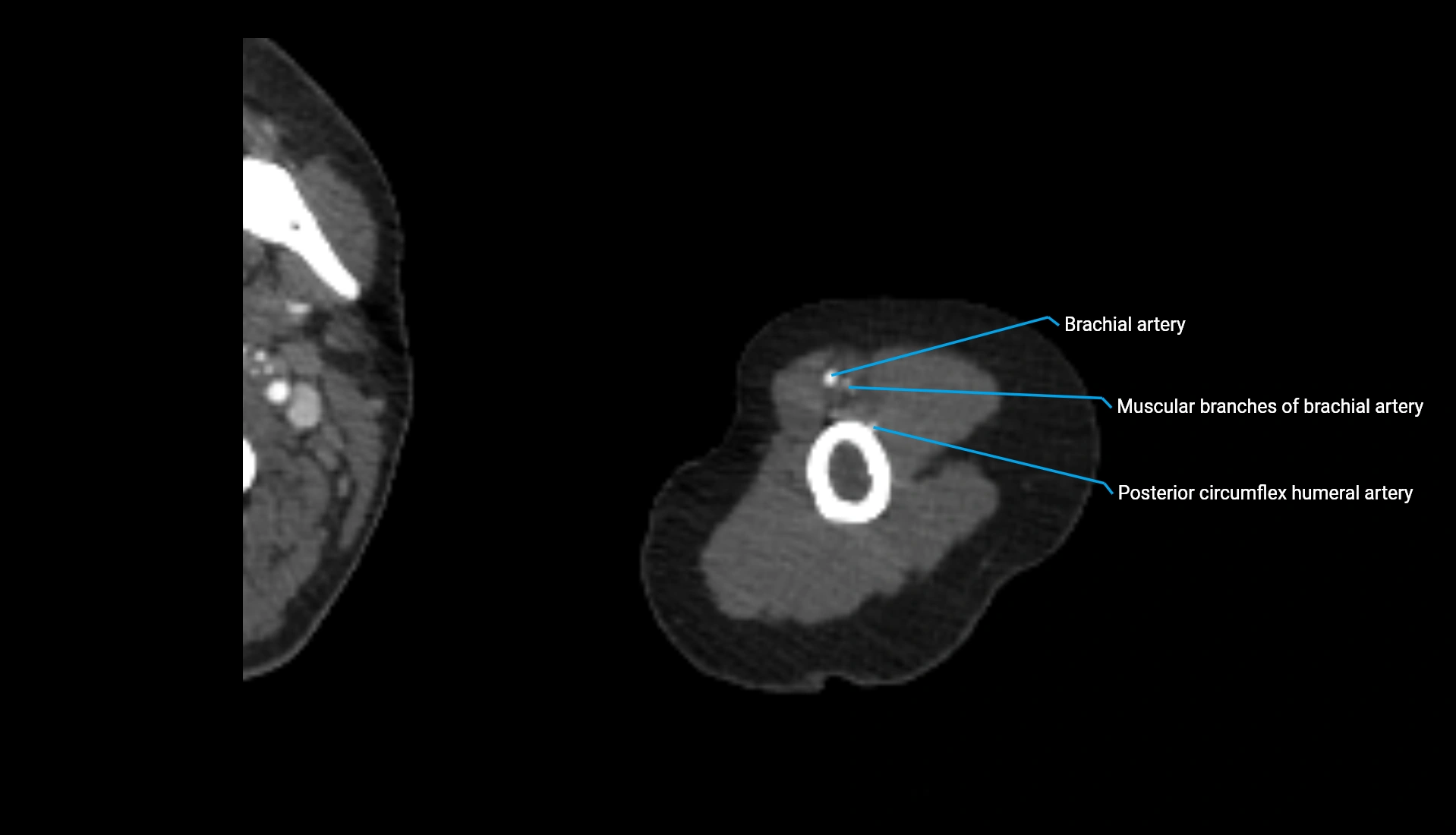 CTA upper limb axial cross sectional anatomy labelled image 290 (2).webp